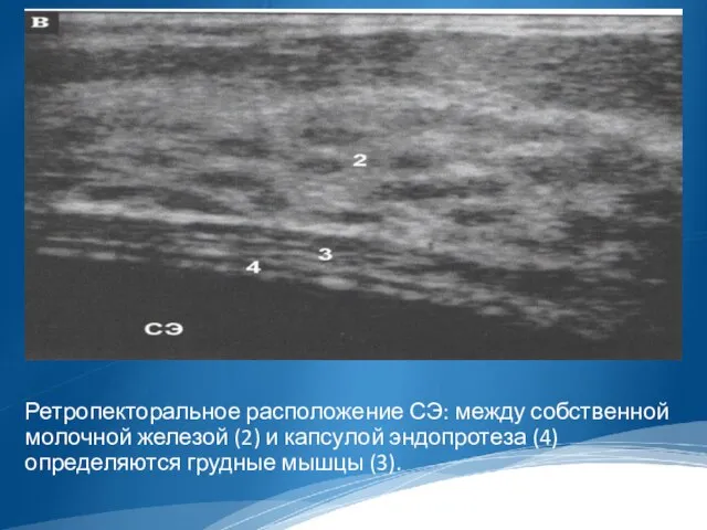 Ретропекторальное расположение СЭ: между собственной молочной железой (2) и капсулой эндопротеза (4) определяются грудные мышцы (3).