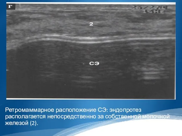 Ретромаммарное расположение СЭ: эндопротез располагается непосредственно за собственной молочной железой (2).