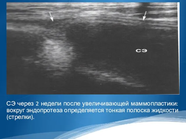СЭ через 2 недели после увеличивающей маммопластики: вокруг эндопротеза определяется тонкая полоска жидкости (стрелки).