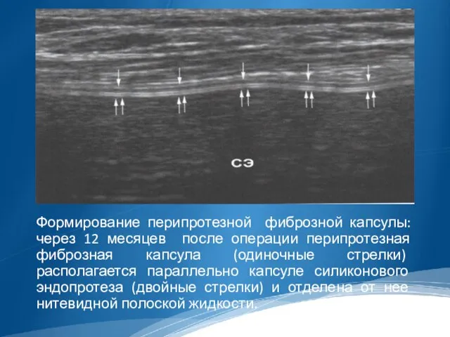 Формирование перипротезной фиброзной капсулы: через 12 месяцев после операции перипротезная фиброзная