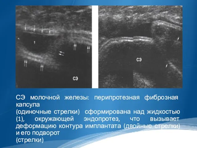 СЭ молочной железы: перипротезная фиброзная капсула (одиночные стрелки) сформирована над жидкостью