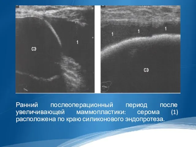 Ранний послеоперационный период после увеличивающей маммопластики: серома (1) расположена по краю силиконового эндопротеза.