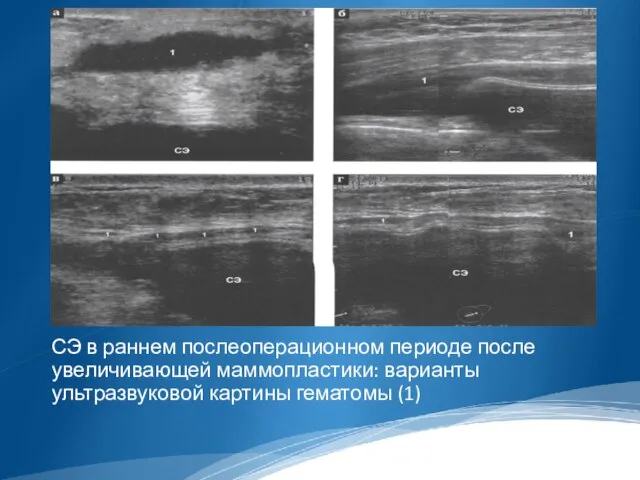 СЭ в раннем послеоперационном периоде после увеличивающей маммопластики: варианты ультразвуковой картины гематомы (1)