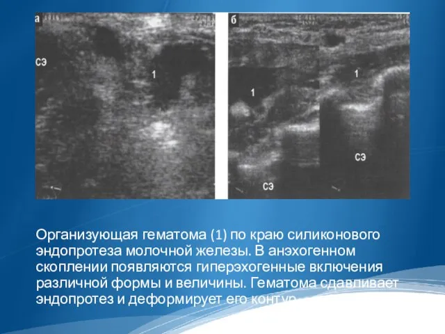 Организующая гематома (1) по краю силиконового эндопротеза молочной железы. В анэхогенном