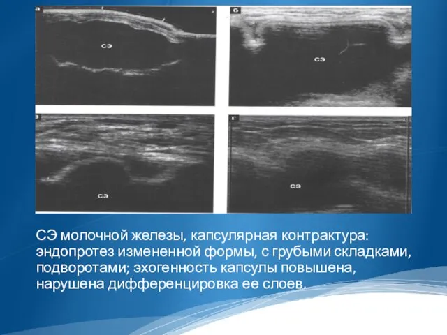 СЭ молочной железы, капсулярная контрактура: эндопротез измененной формы, с грубыми складками,
