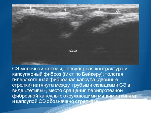 СЭ молочной железы, капсулярная контрактура и капсулярный фиброз (IV ст по