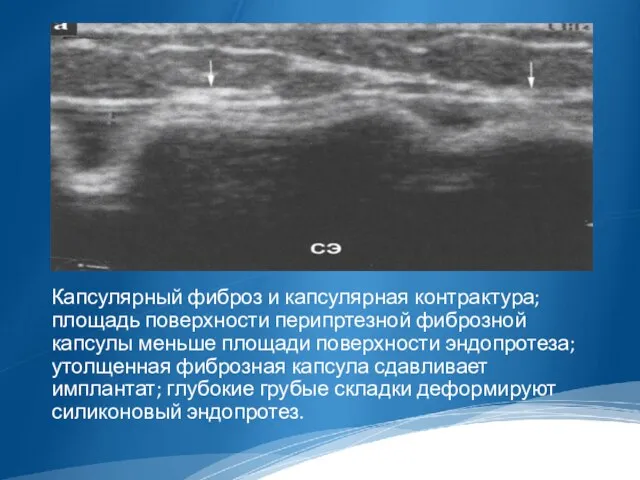 Капсулярный фиброз и капсулярная контрактура; площадь поверхности перипртезной фиброзной капсулы меньше