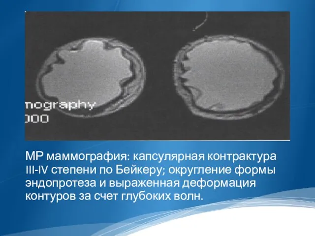 МР маммография: капсулярная контрактура III-IV степени по Бейкеру; округление формы эндопротеза