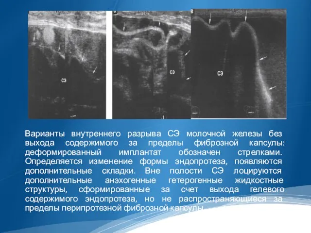 Варианты внутреннего разрыва СЭ молочной железы без выхода содержимого за пределы