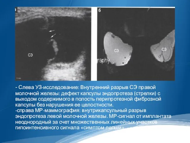 - Слева УЗ-исследование: Внутренний разрыв СЭ правой молочной железы: дефект капсулы