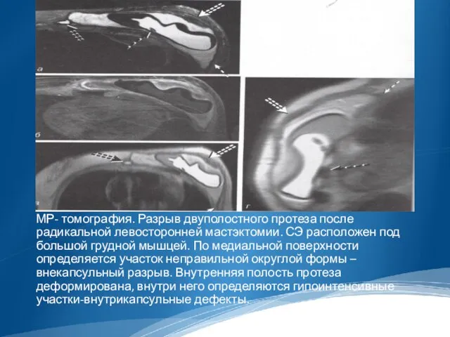 МР- томография. Разрыв двуполостного протеза после радикальной левосторонней мастэктомии. СЭ расположен