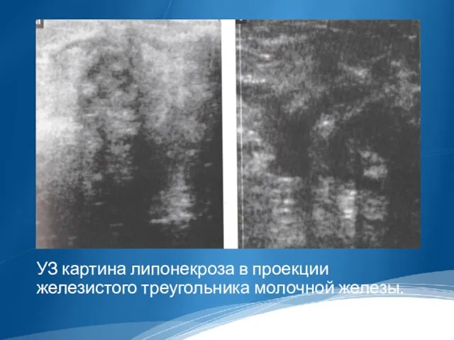 УЗ картина липонекроза в проекции железистого треугольника молочной железы.