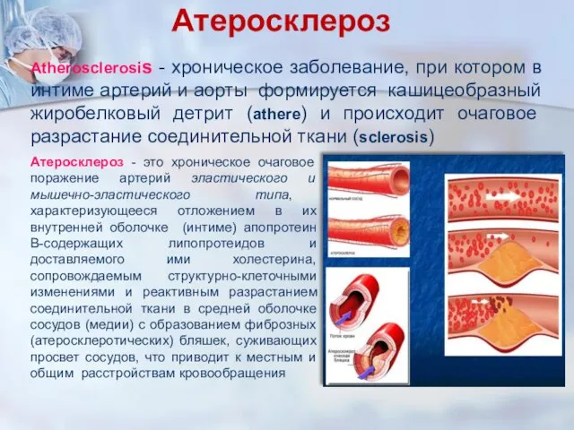 Атеросклероз Атеросклероз - это хроническое очаговое поражение артерий эластического и мышечно-эластического