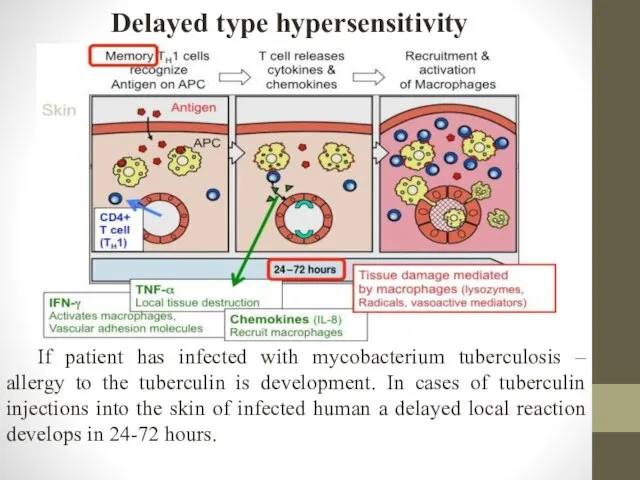 Delayed type hypersensitivity If patient has infected with mycobacterium tuberculosis –