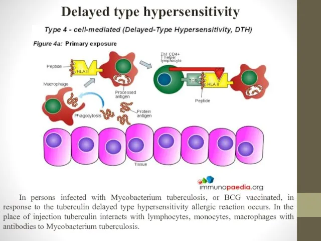 Delayed type hypersensitivity In persons infected with Mycobacterium tuberculosis, or BCG