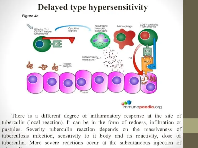 Delayed type hypersensitivity There is a different degree of inflammatory response