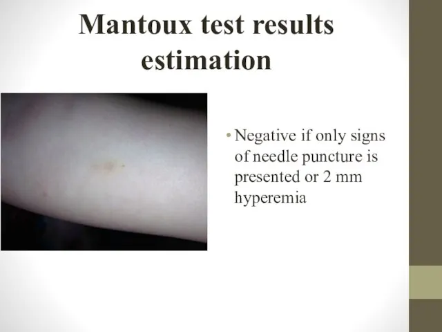 Mantoux test results estimation Negative if only signs of needle puncture