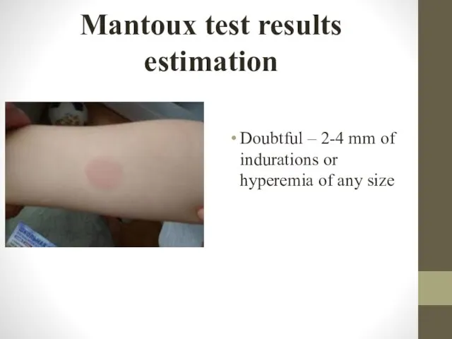 Mantoux test results estimation Doubtful – 2-4 mm of indurations or hyperemia of any size