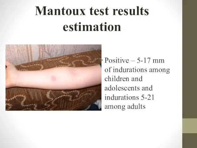 Mantoux test results estimation Positive – 5-17 mm of indurations among