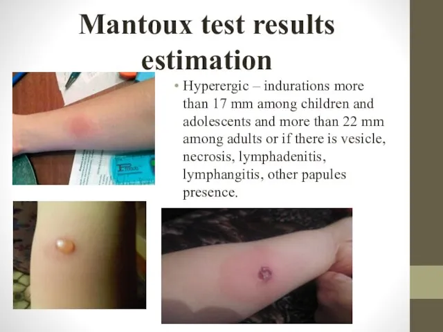 Mantoux test results estimation Hyperergic – indurations more than 17 mm