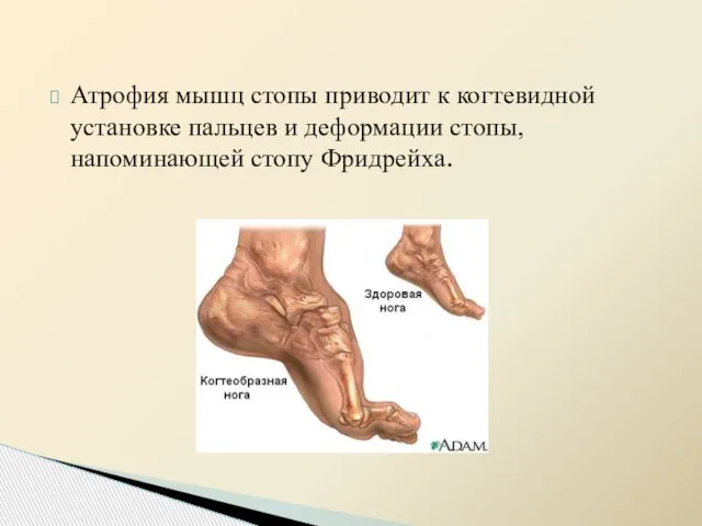 Атрофия мышц стопы приводит к когтевидной установке пальцев и деформации стопы, напоминающей стопу Фридрейха.