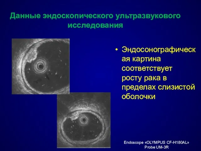 Данные эндоскопического ультразвукового исследования Эндосонографическая картина соответствует росту рака в пределах