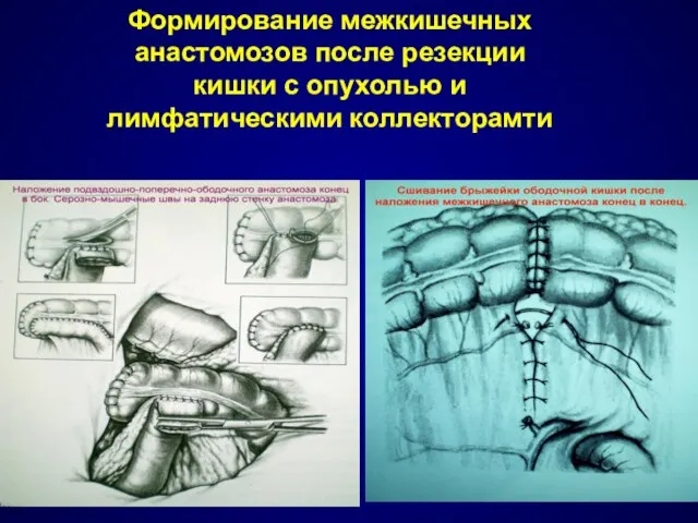 Формирование межкишечных анастомозов после резекции кишки с опухолью и лимфатическими коллекторамти