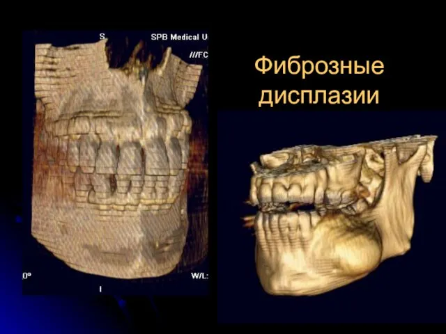 Фиброзные дисплазии