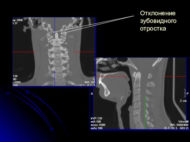 Отклонение зубовидного отростка