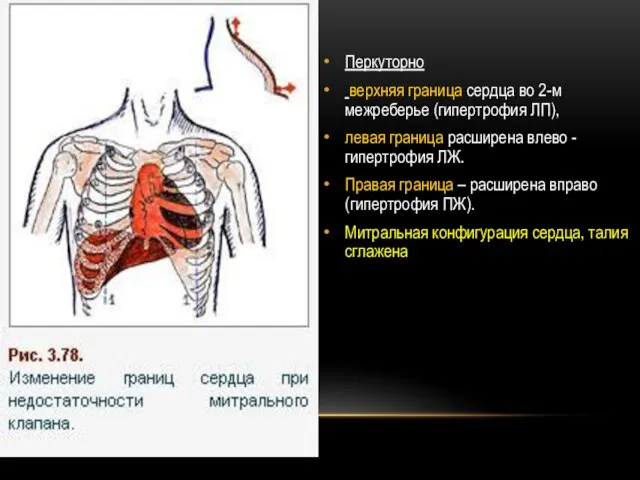 Перкуторно верхняя граница сердца во 2-м межреберье (гипертрофия ЛП), левая граница