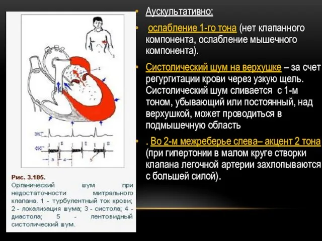 Аускультативно: ослабление 1-го тона (нет клапанного компонента, ослабление мышечного компонента). Систолический