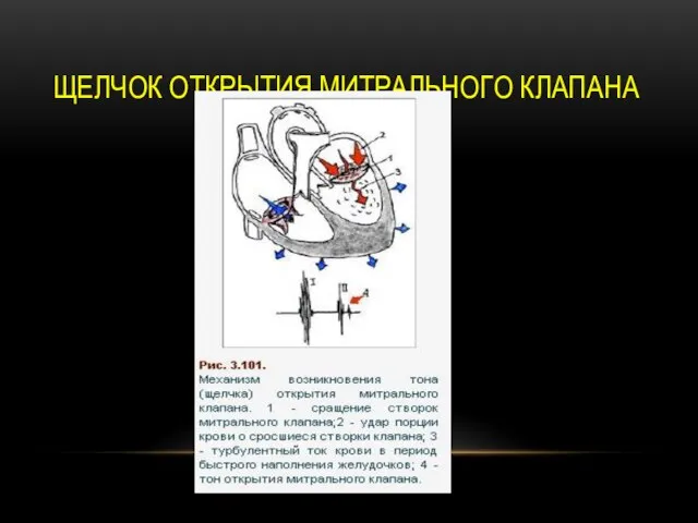 ЩЕЛЧОК ОТКРЫТИЯ МИТРАЛЬНОГО КЛАПАНА