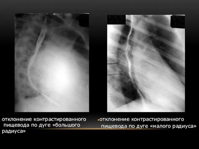 отклонение контрастированного пищевода по дуге «малого радиуса» отклонение контрастированного пищевода по дуге «большого радиуса»