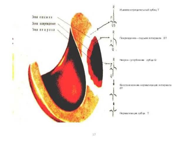 Ишемия-отрица­тельный зубец Т Повреждение—подъем интервала ST Некроз—углубле­ние зубца Q Восстановление-нормализация интервала ST Нормализация зубца Т