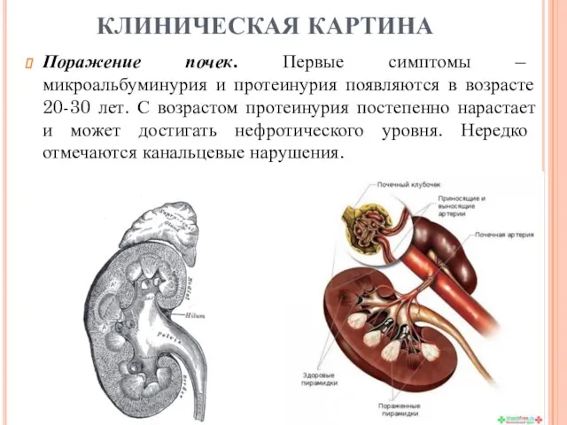 Поражение почек. Первые симптомы – микроальбуминурия и протеинурия появляются в возрасте