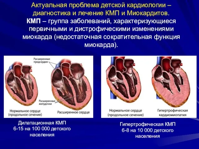 Актуальная проблема детской кардиологии – диагностика и лечение КМП и Миокардитов.