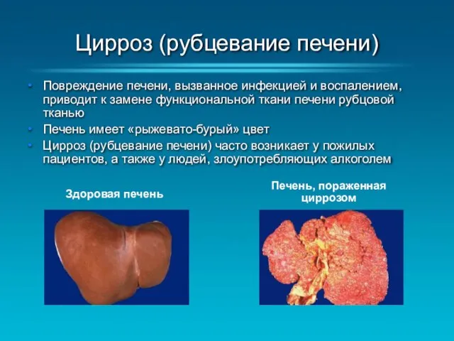 Цирроз (рубцевание печени) Повреждение печени, вызванное инфекцией и воспалением, приводит к
