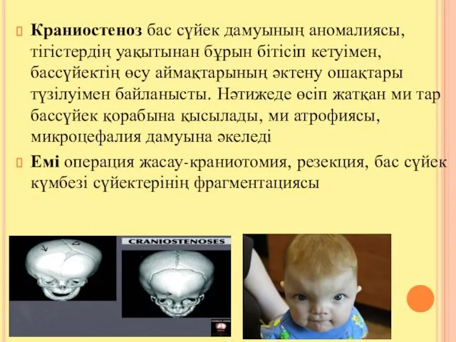 Краниостеноз бас сүйек дамуының аномалиясы, тігістердің уақытынан бұрын бітісіп кетуімен, бассүйектің