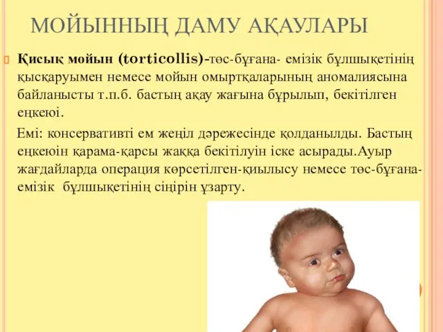 МОЙЫННЫҢ ДАМУ АҚАУЛАРЫ Қисық мойын (torticollis)-төс-бұғана- емізік бұлшықетінің қысқаруымен немесе мойын