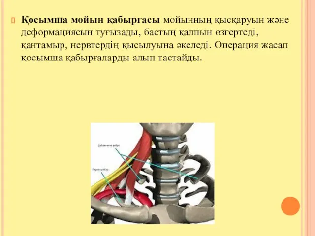 Қосымша мойын қабырғасы мойынның қысқаруын және деформациясын туғызады, бастың қалпын өзгертеді,