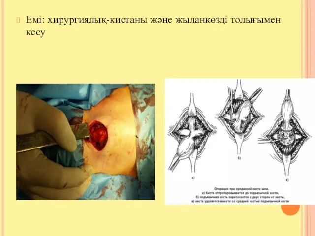 Емі: хирургиялық-кистаны және жыланкөзді толығымен кесу