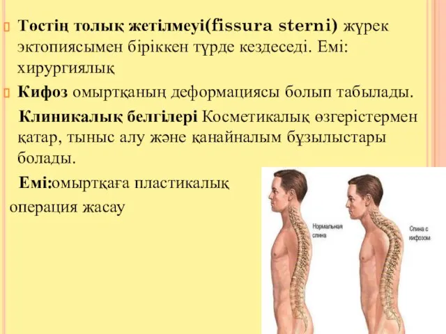 Төстің толық жетілмеуі(fissura sterni) жүрек эктопиясымен біріккен түрде кездеседі. Емі: хирургиялық