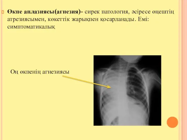 Өкпе аплазиясы(агнезия)- сирек патология, әсіресе өңештің атрезиясымен, көкеттік жарықпен қосарланады. Емі: симптоматикалық Оң өкпенің агнезиясы