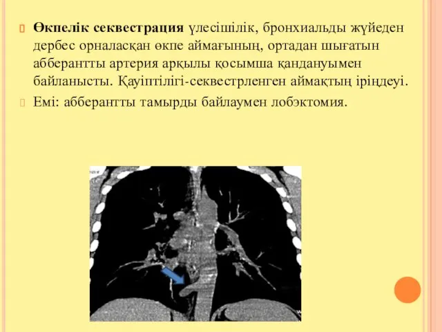 Өкпелік секвестрация үлесішілік, бронхиальды жүйеден дербес орналасқан өкпе аймағының, ортадан шығатын