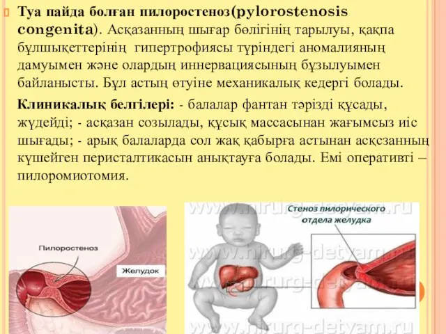 Туа пайда болған пилоростеноз(pylorostenosis congenita). Асқазанның шығар бөлігінің тарылуы, қақпа бұлшықеттерінің