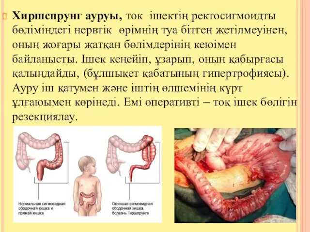 Хиршспрунг ауруы, ток ішектің ректосигмоидты бөліміндегі нервтік өрімнің туа бітген жетілмеуінен,