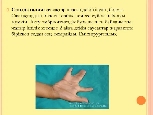 Синдактилия саусақтар арасында бітісудің болуы. Саусақтардың бітісуі терілік немесе сүйектік болуы