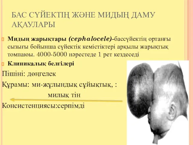 БАС СҮЙЕКТІҢ ЖӘНЕ МИДЫҢ ДАМУ АҚАУЛАРЫ Мидың жарықтары (cephalocele)-бассүйектің ортанғы сызығы