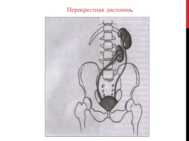 Перекрестная дистопия.