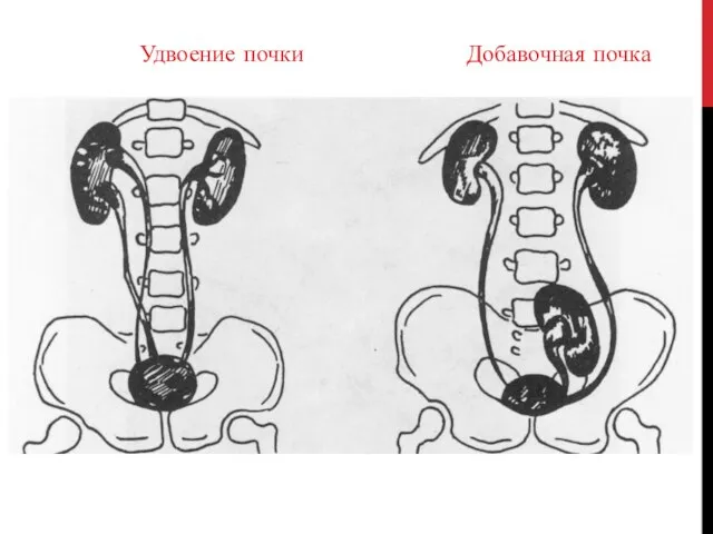 Удвоение почки Добавочная почка